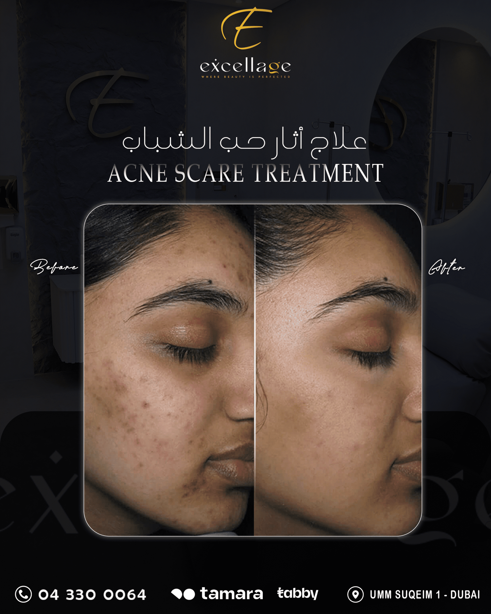 Acne Scar 2