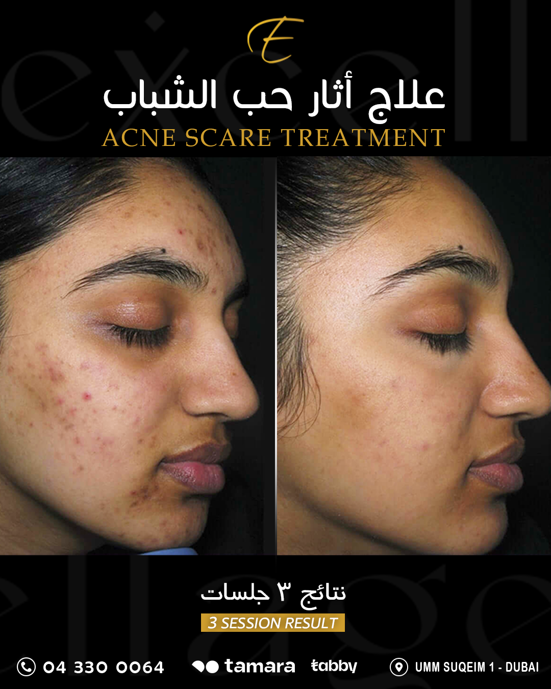Acne Scar_