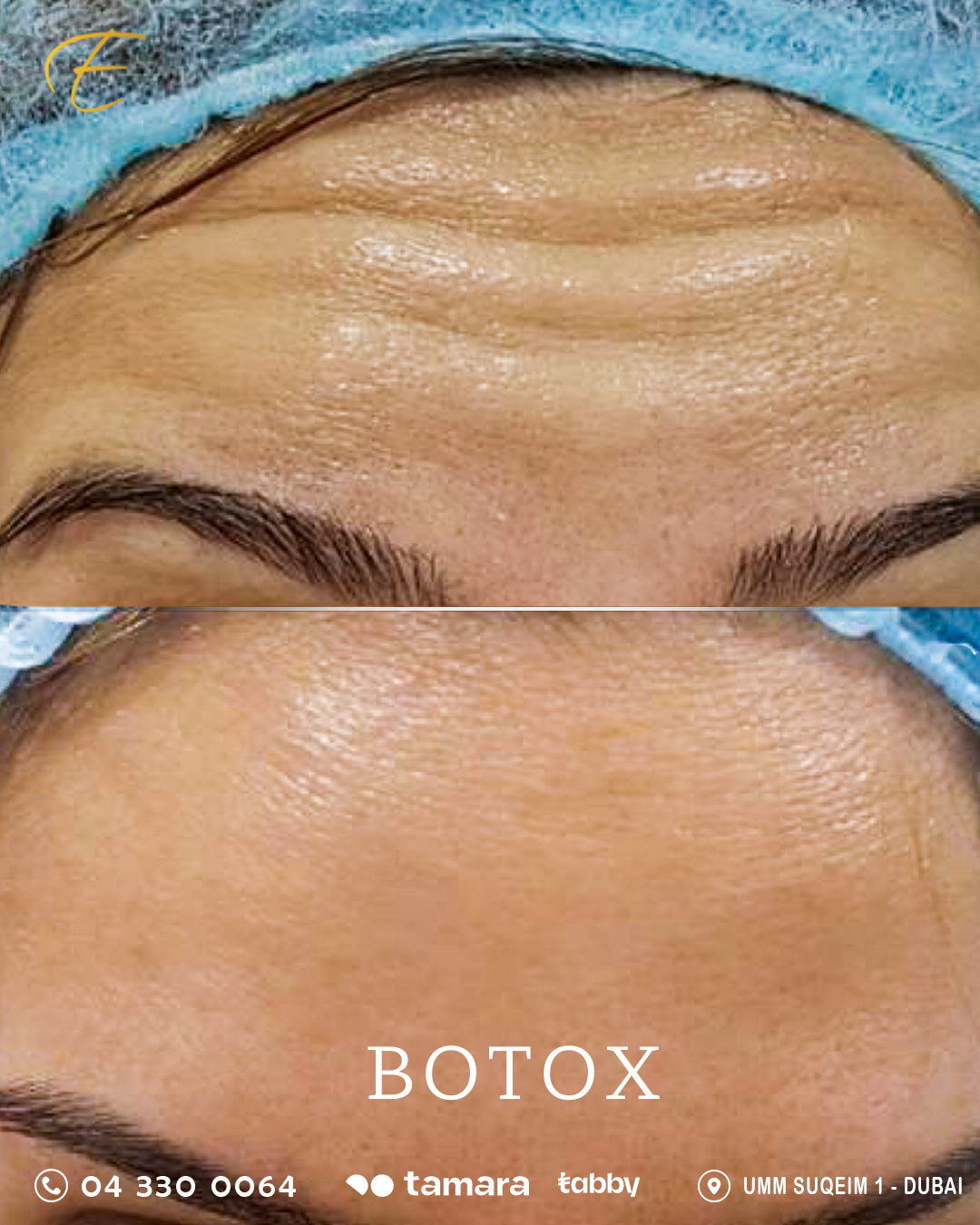 Botox