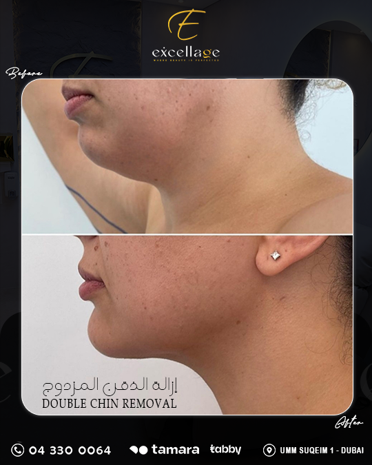 Double Chin removal 2