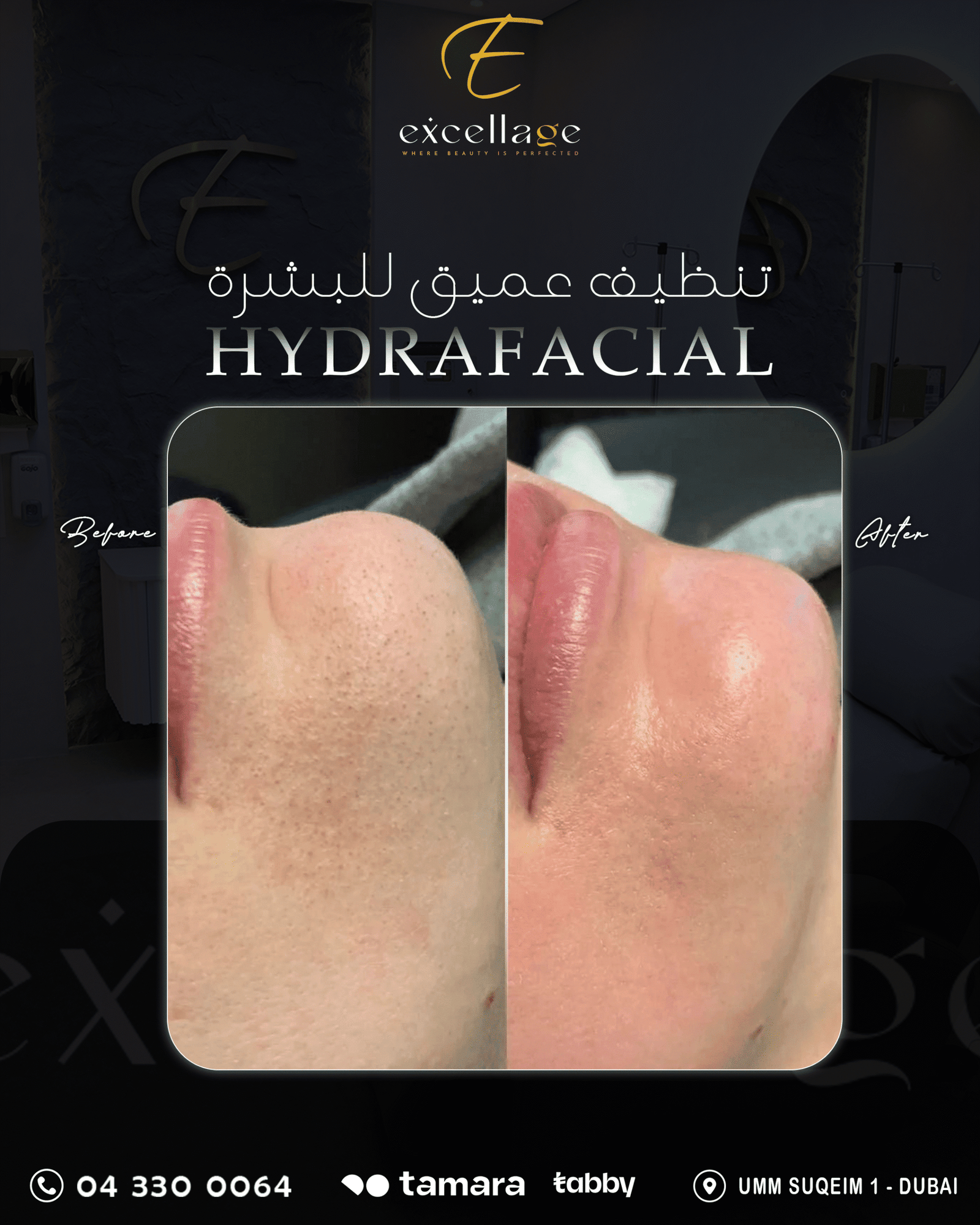 Hydrafacial 2