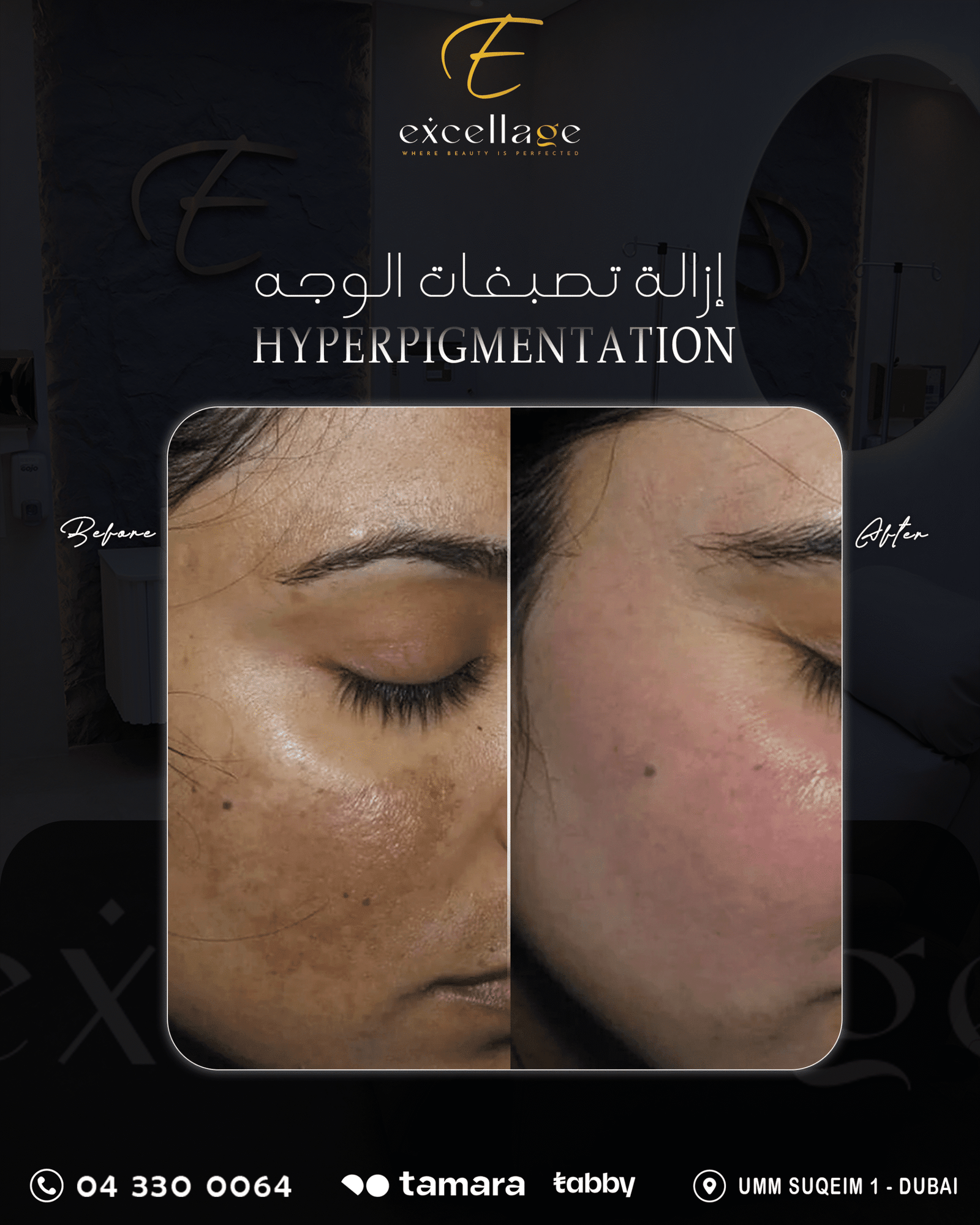 Hyperpigmentation 2