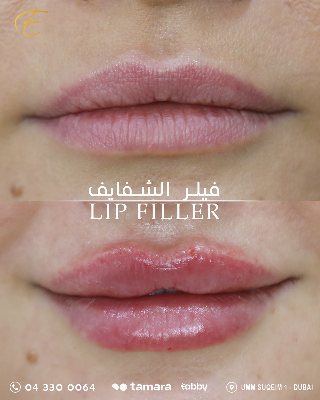 Lip Filler_