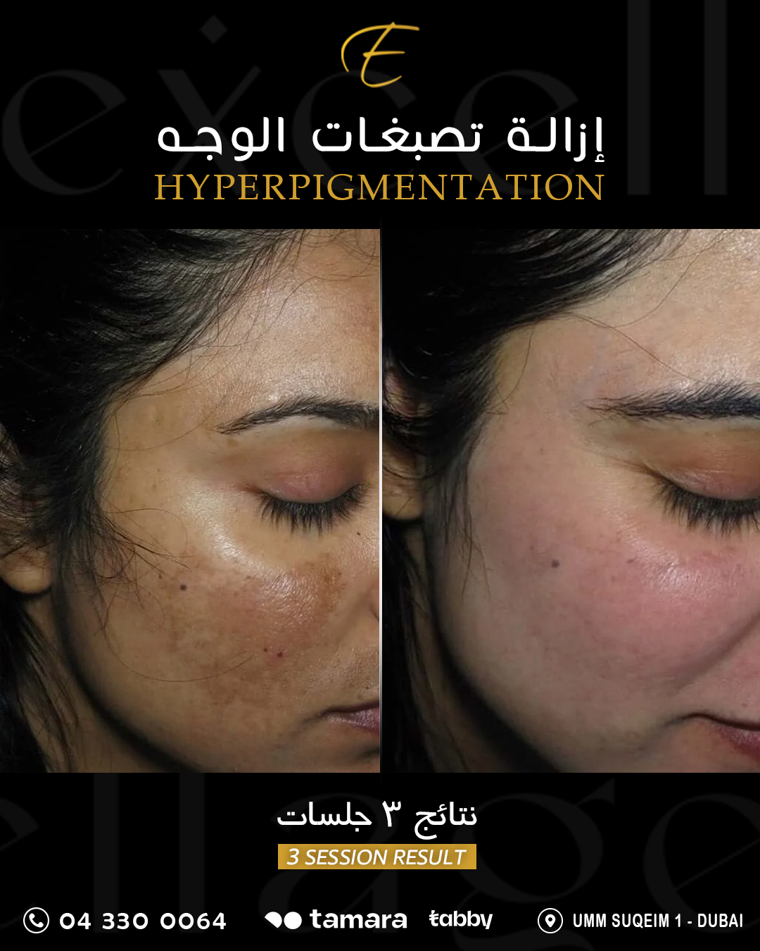 Pigmentation Face