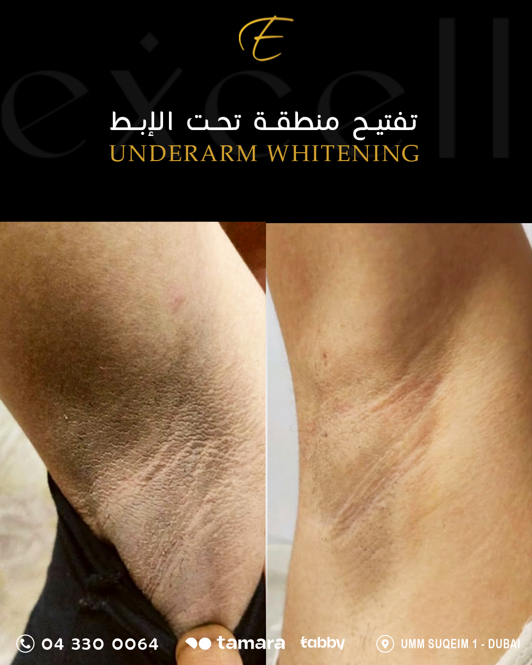 Underarm Whitening