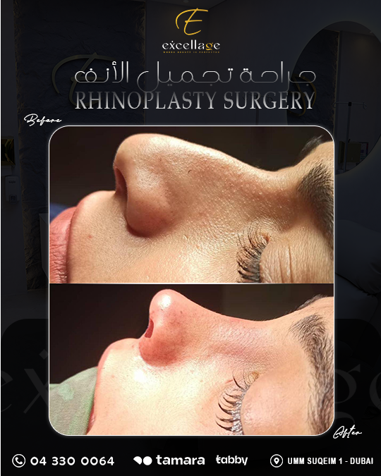 rhinoplasty surgery 2