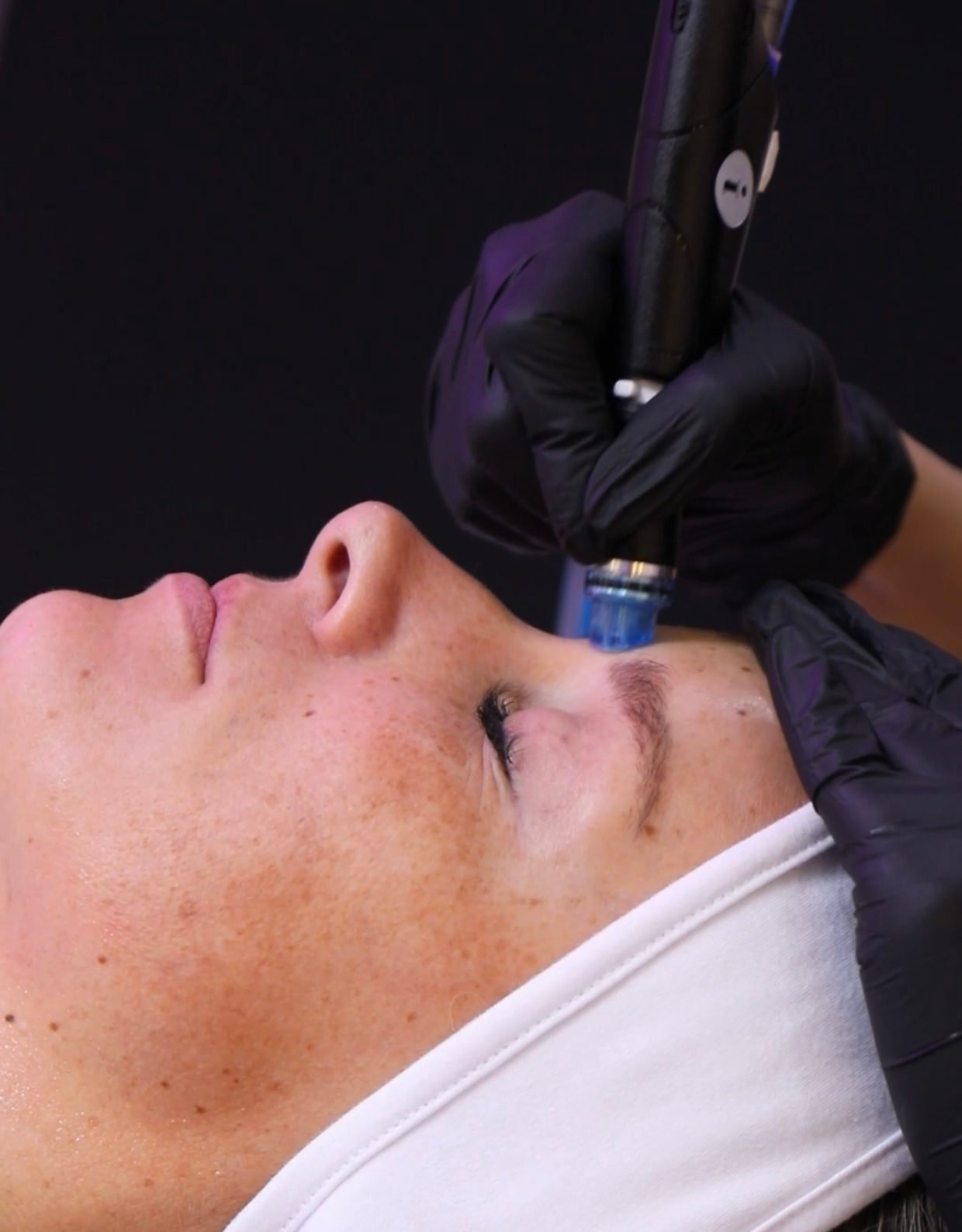 HydraFacial Treatment facial, carbon facial, deep cleansing,