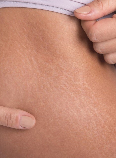 Stretch Marks Treatment Dubai