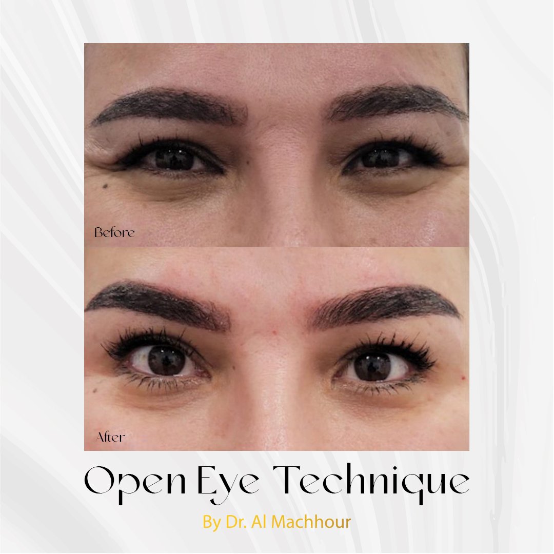 The Open Eye Technique in Dubai : Transform Your Look