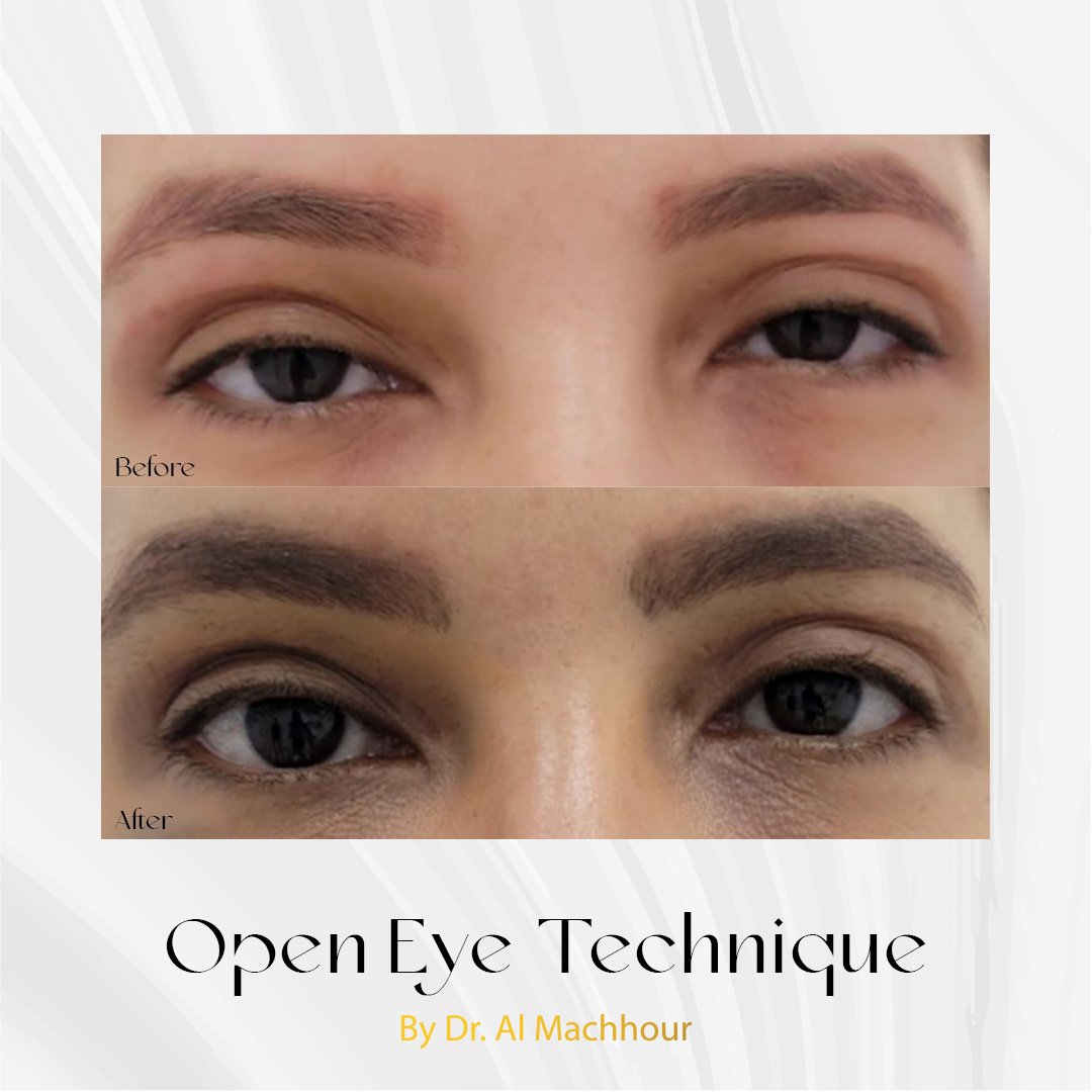 Open Eye technique botox under eye botox