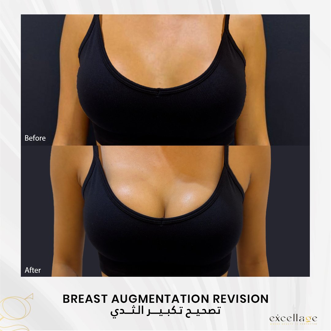 Breast augmentation revision