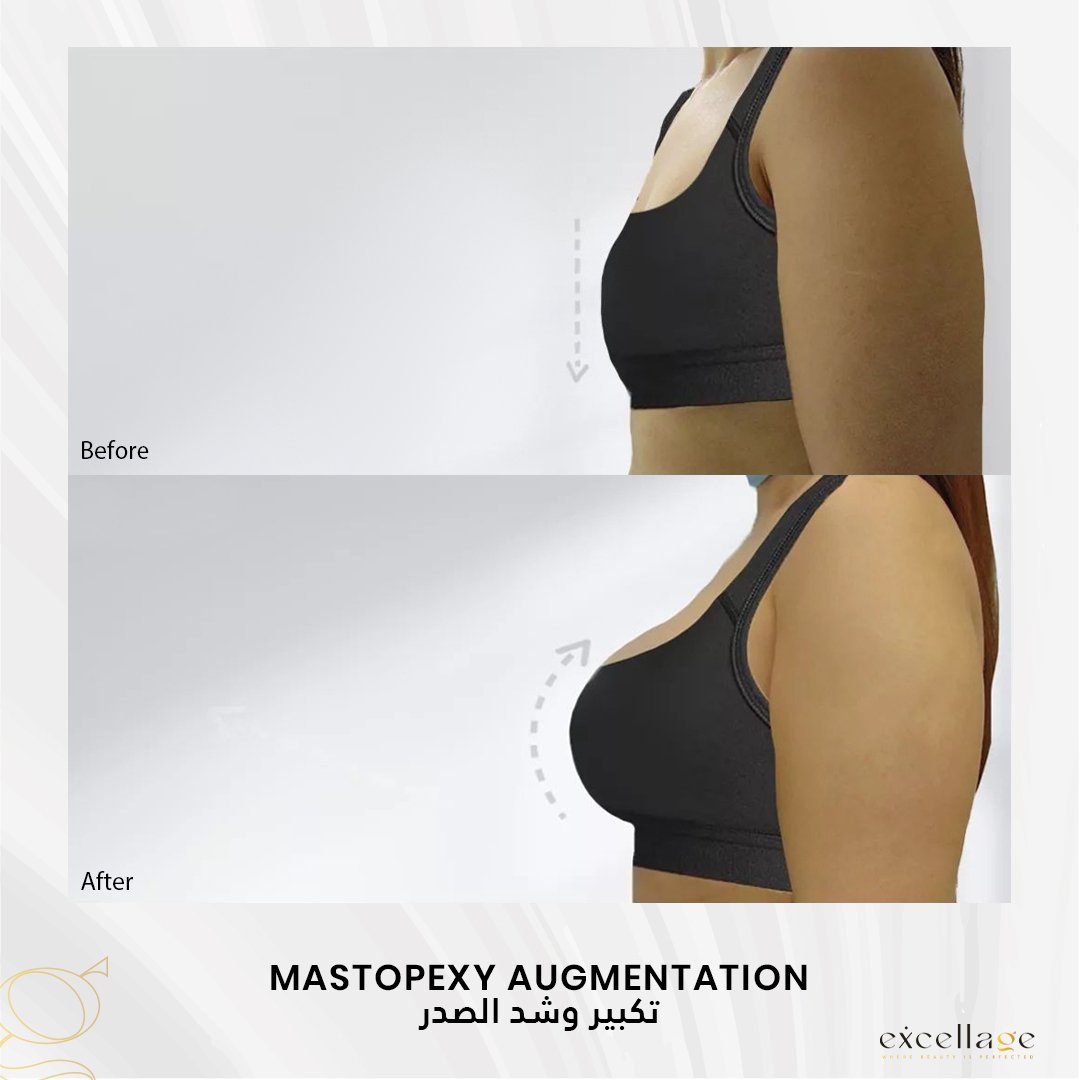 Mastopexy augmentation