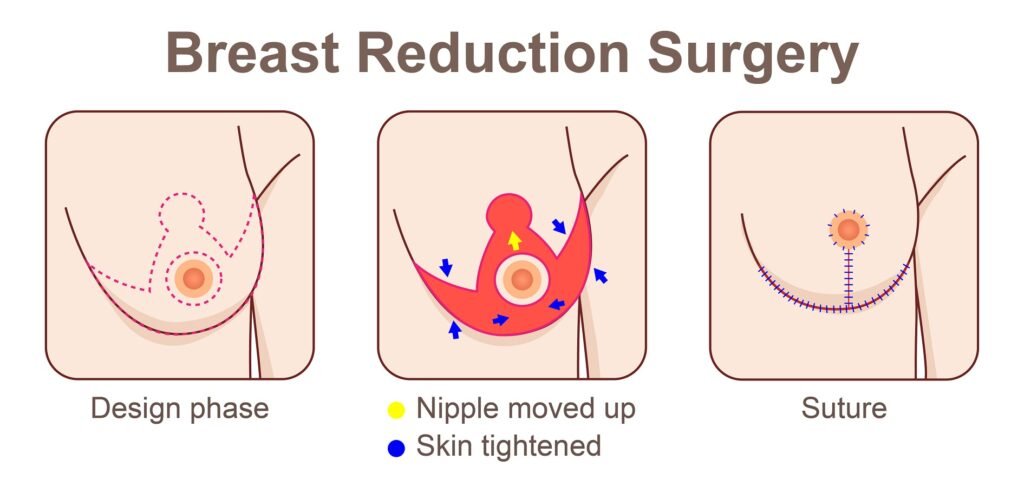 breast-reduction-surgery excellage