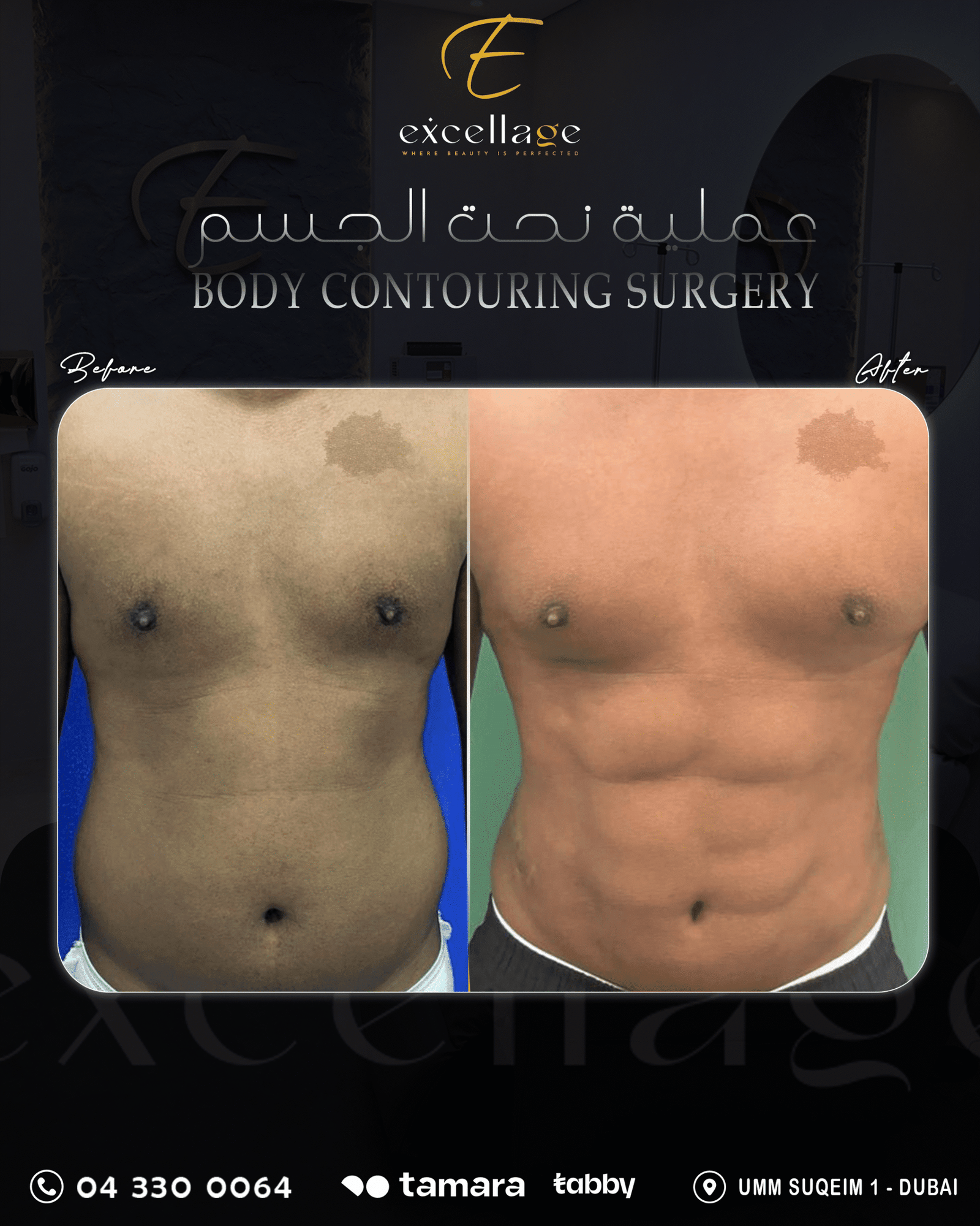 Body Contouring Surgery 1