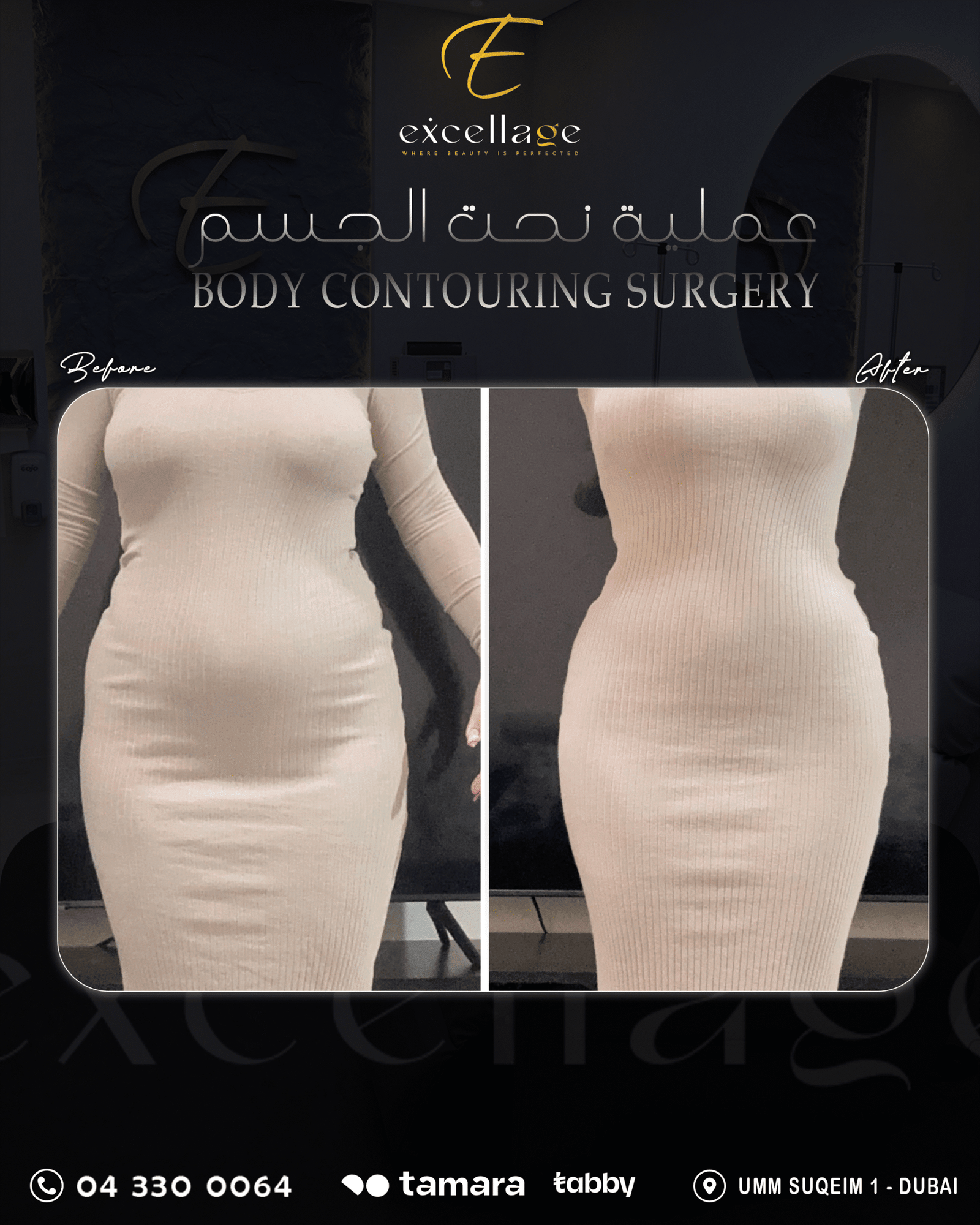 Body Contouring Surgery 3