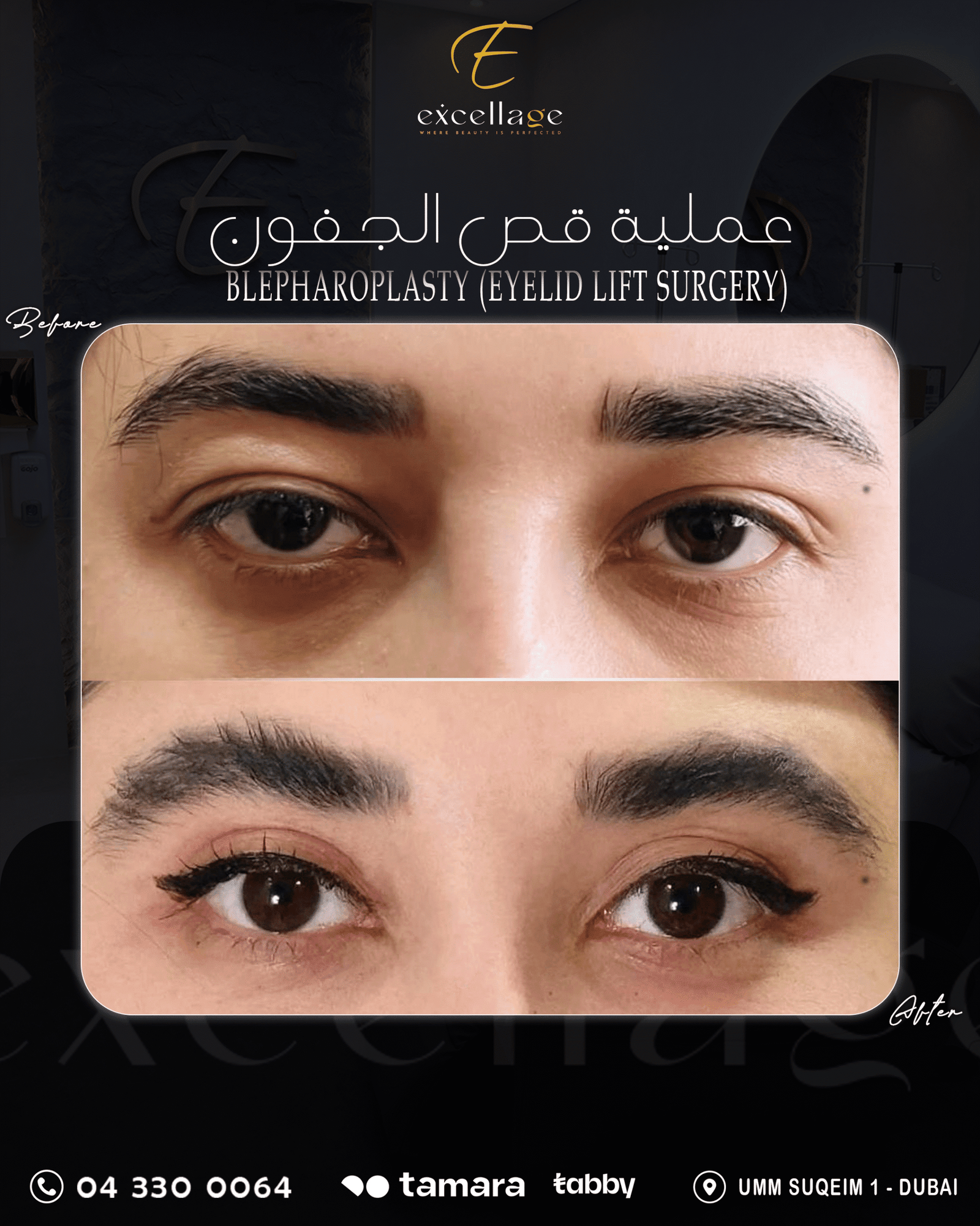 Eyelid Lift Surgery 1