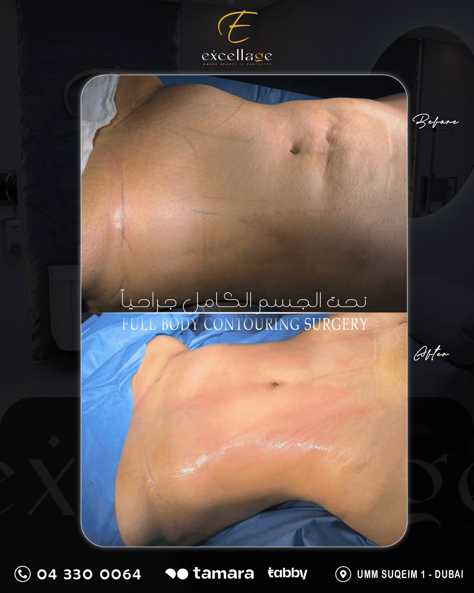 full body contouring surgery 1