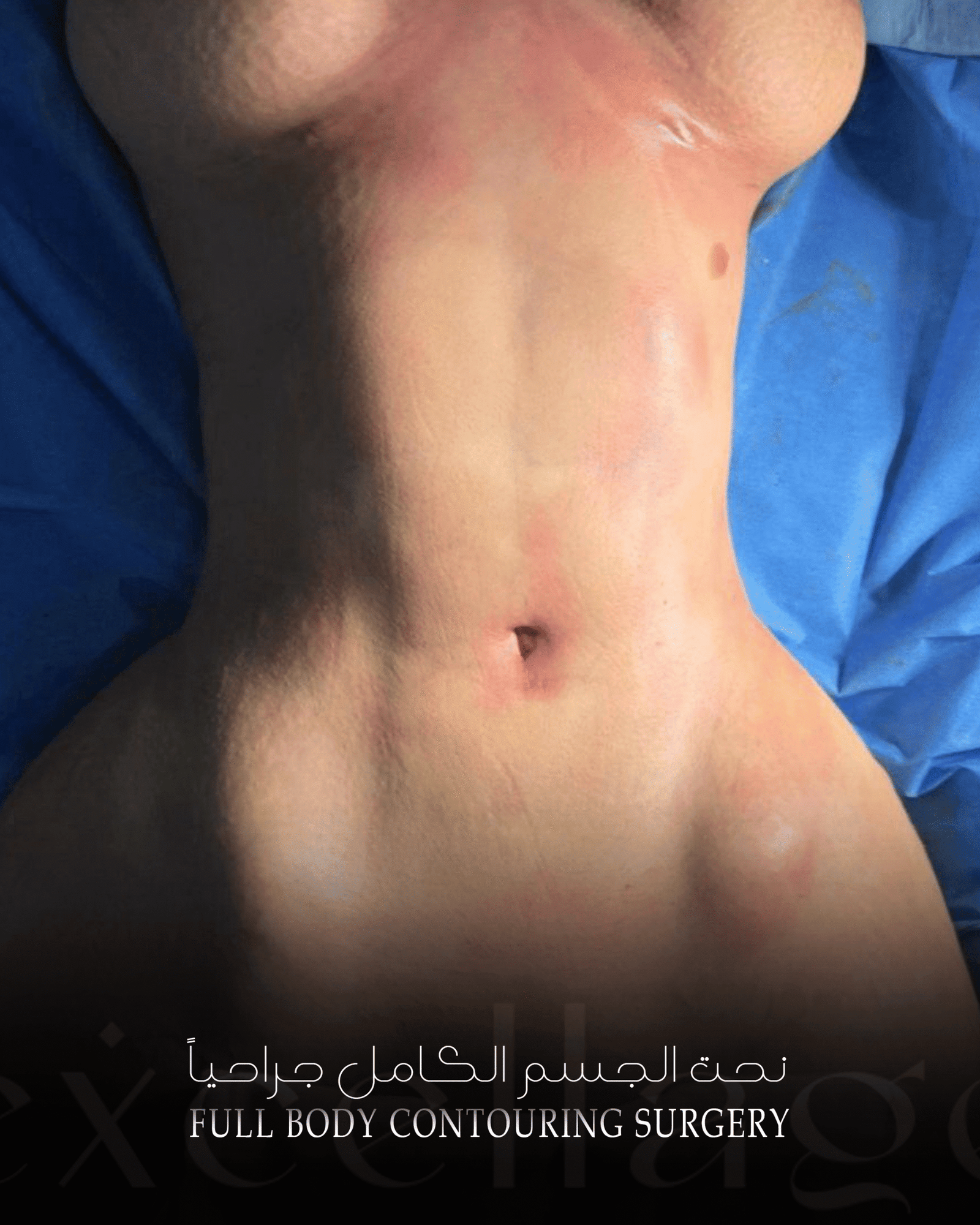 full body contouring surgery 2