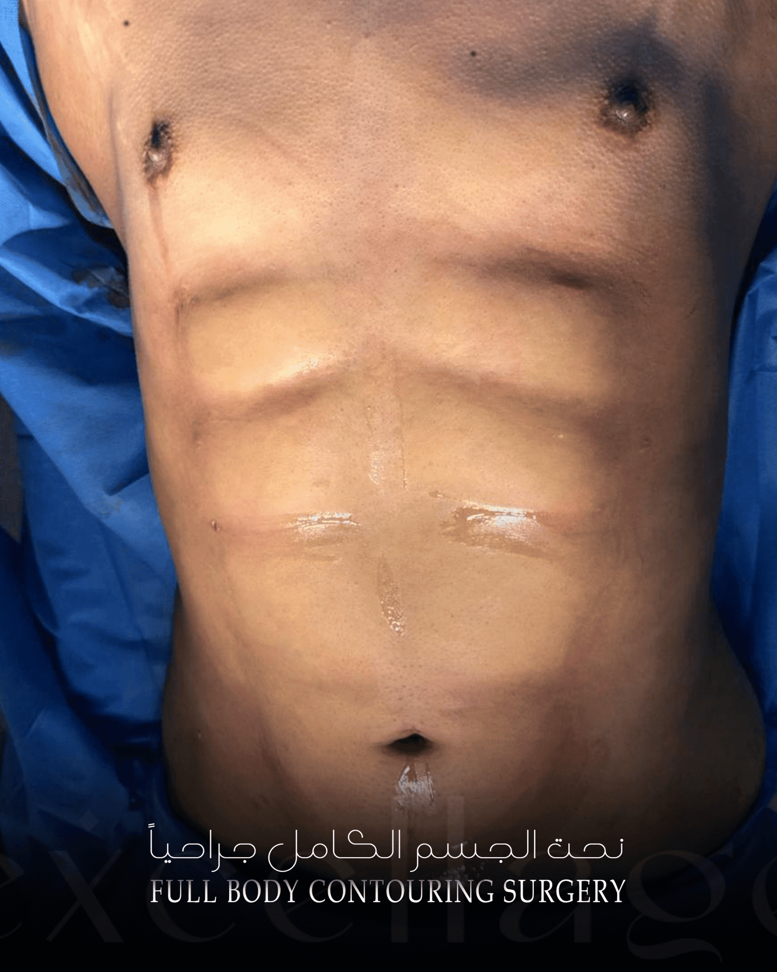 full body contouring surgery 3