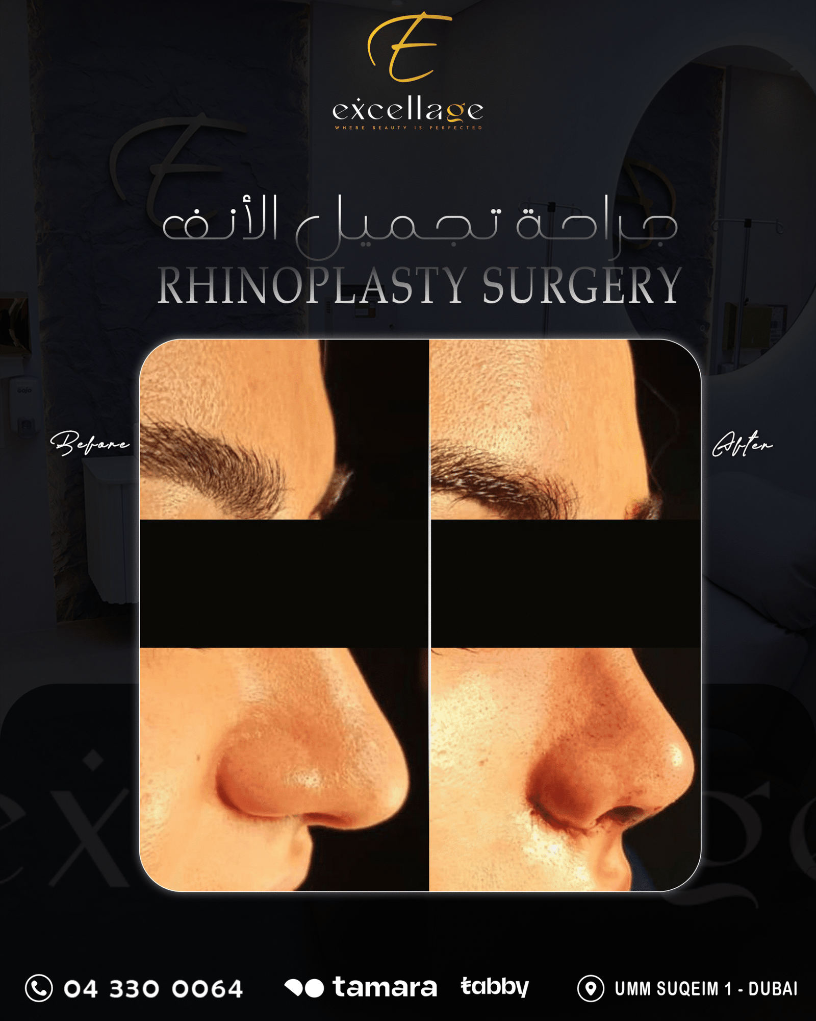 rhinoplasty surgery 1